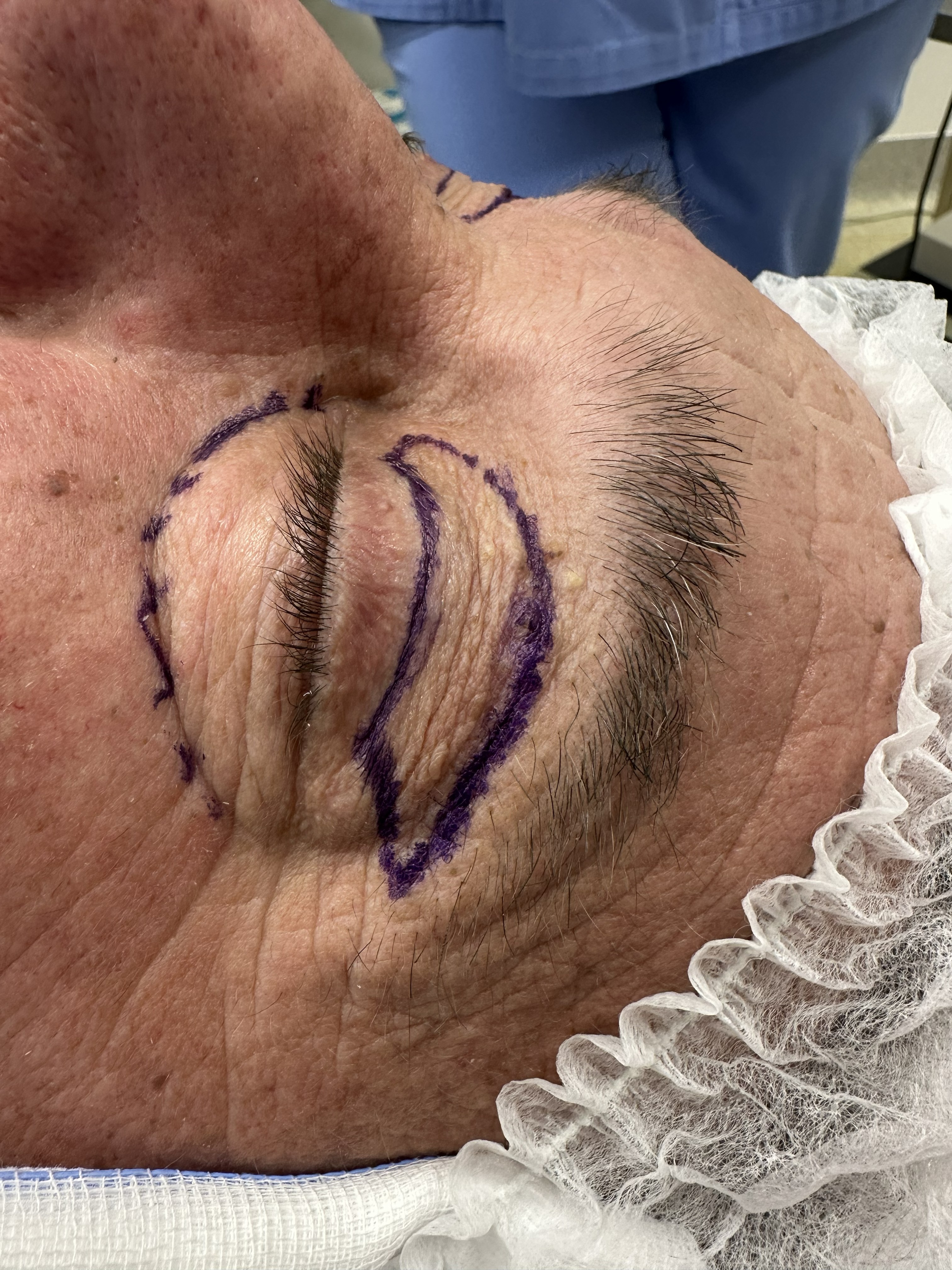 Blefaroplastika